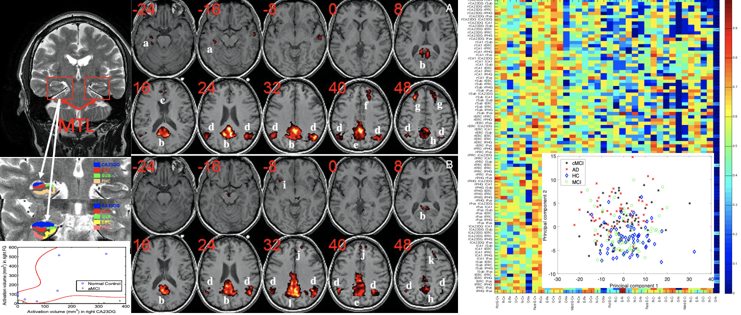fMRI data analysis and prediction of neurodegenerative disease